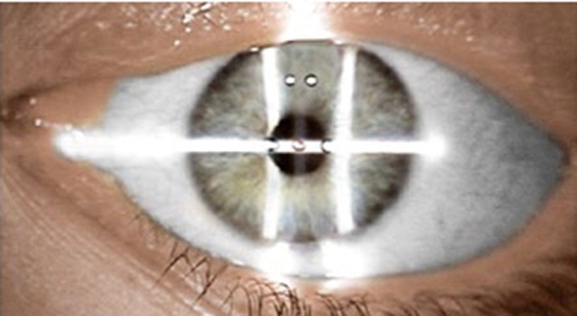 認識近視與TransPRK近視雷射手術01